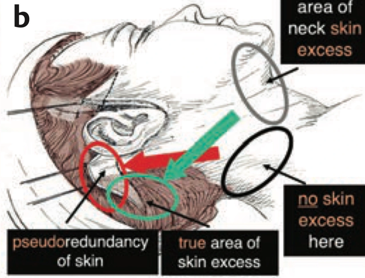 Skin direction during lifting procedures