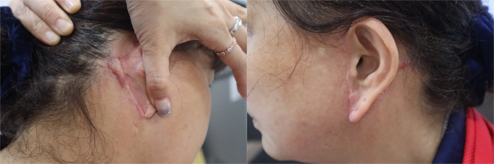 facelift scars