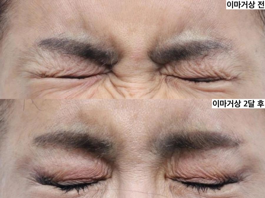 Frowning picture before and after brow lift