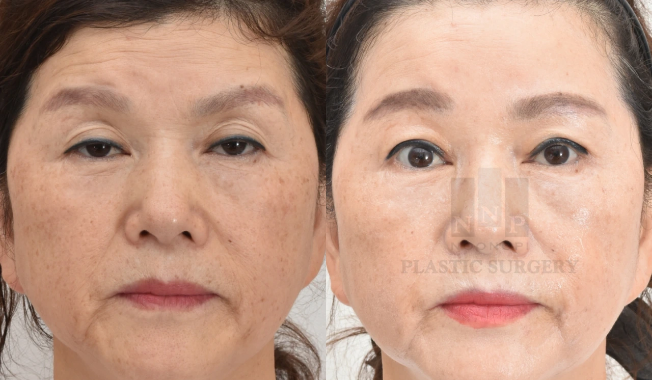 Brow lift with double eyelid surgery combined