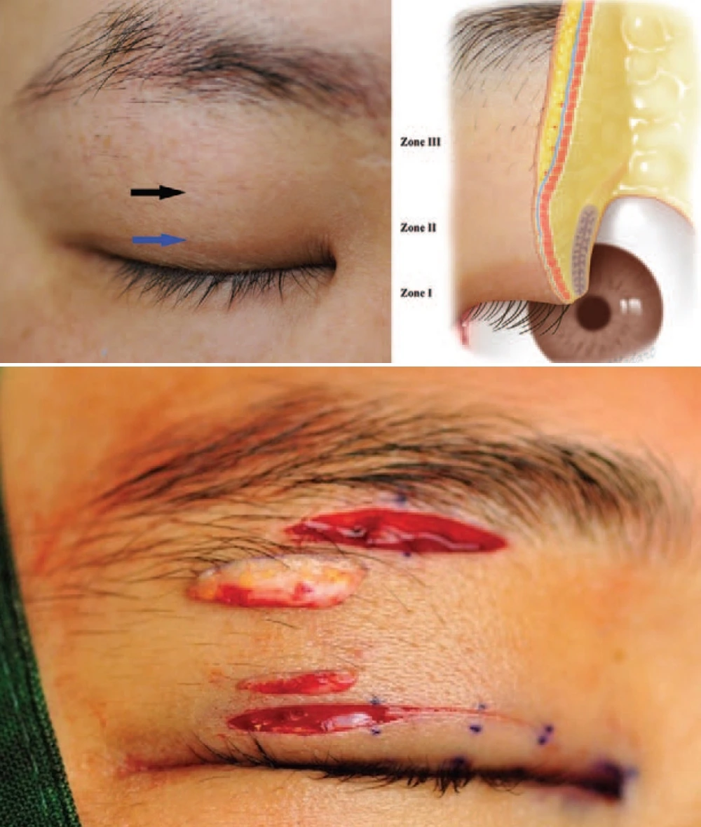 Skin thickness comparison