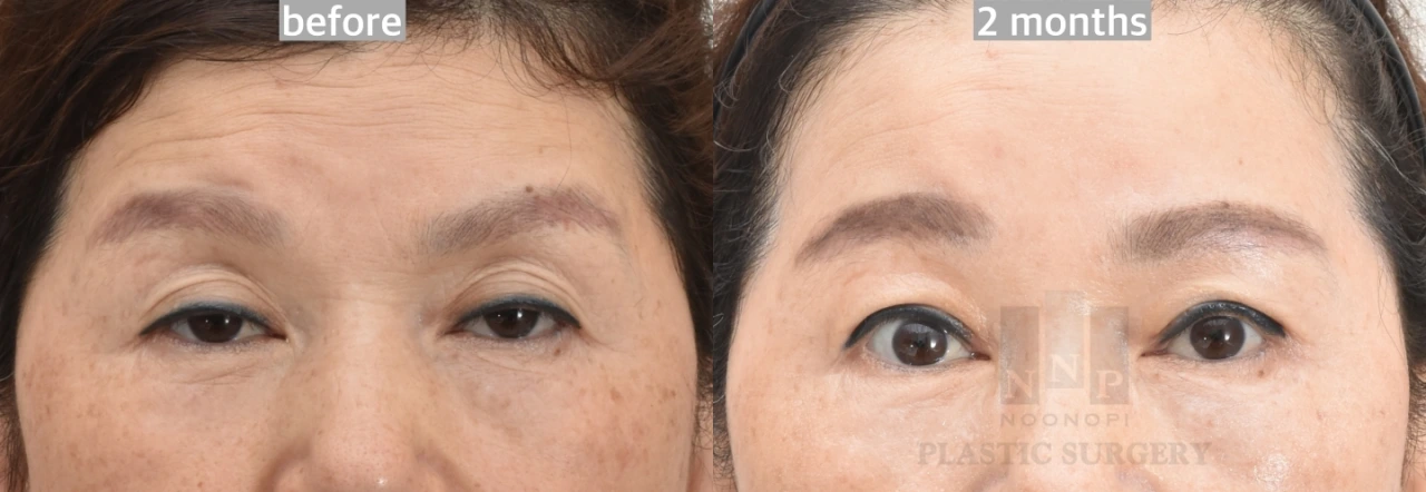forehead lift with sleepy eyelid surgery results