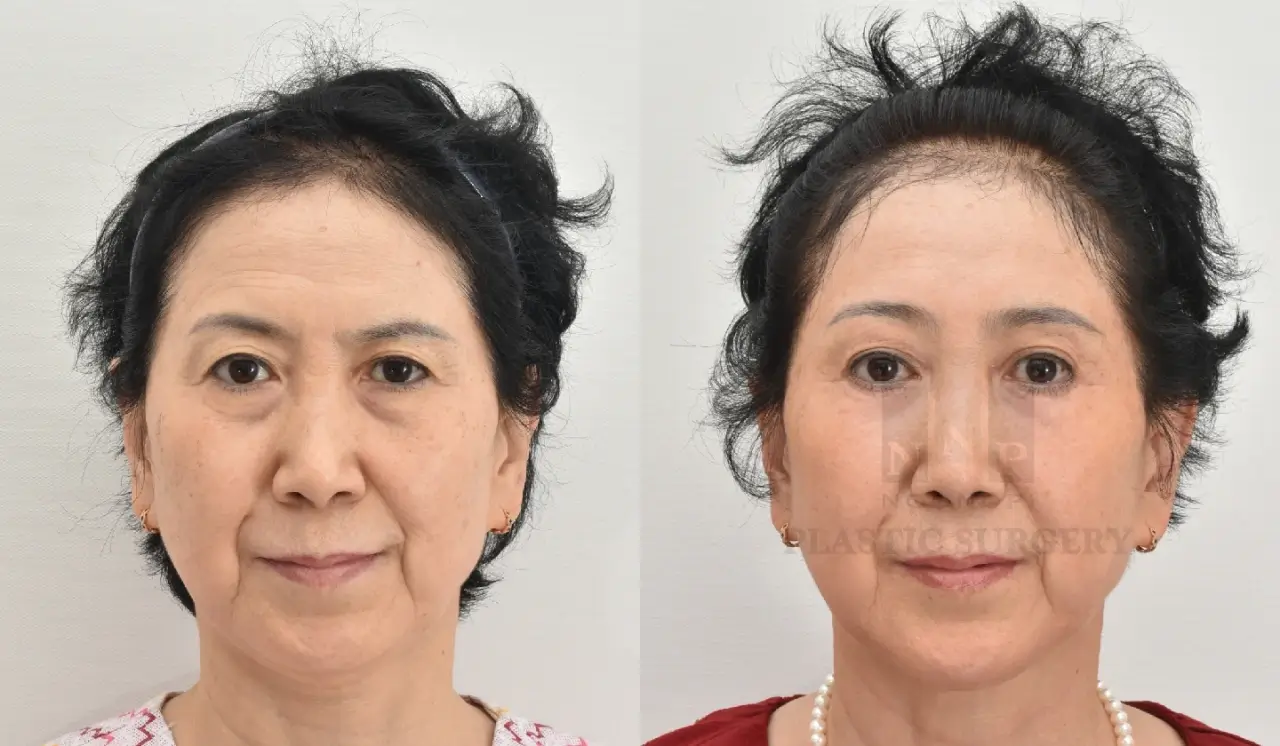 Korean brow lift before after photo