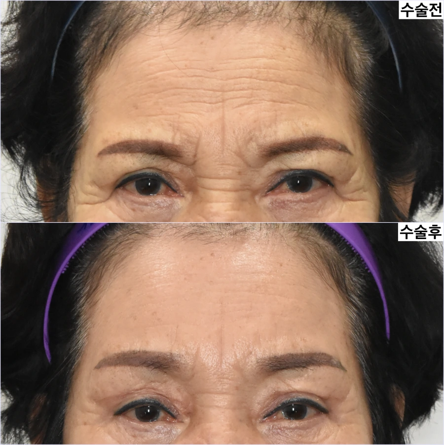 Fine lines may still visible after endoscopic brow lift