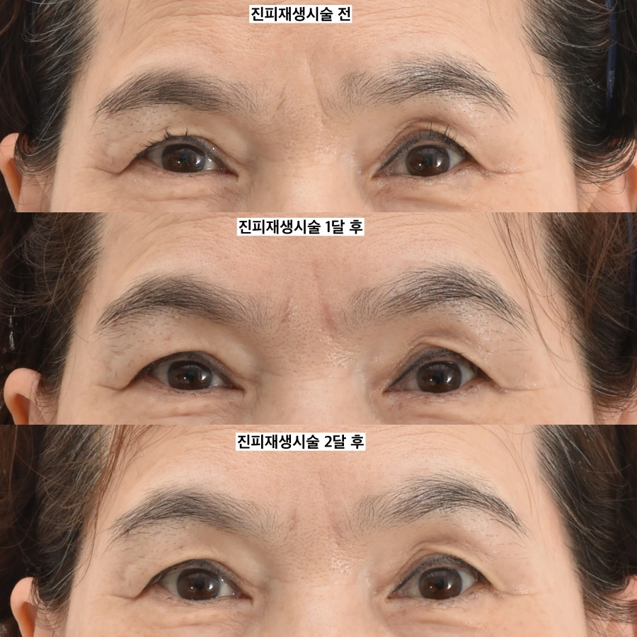 glabellar wrinkle fillers