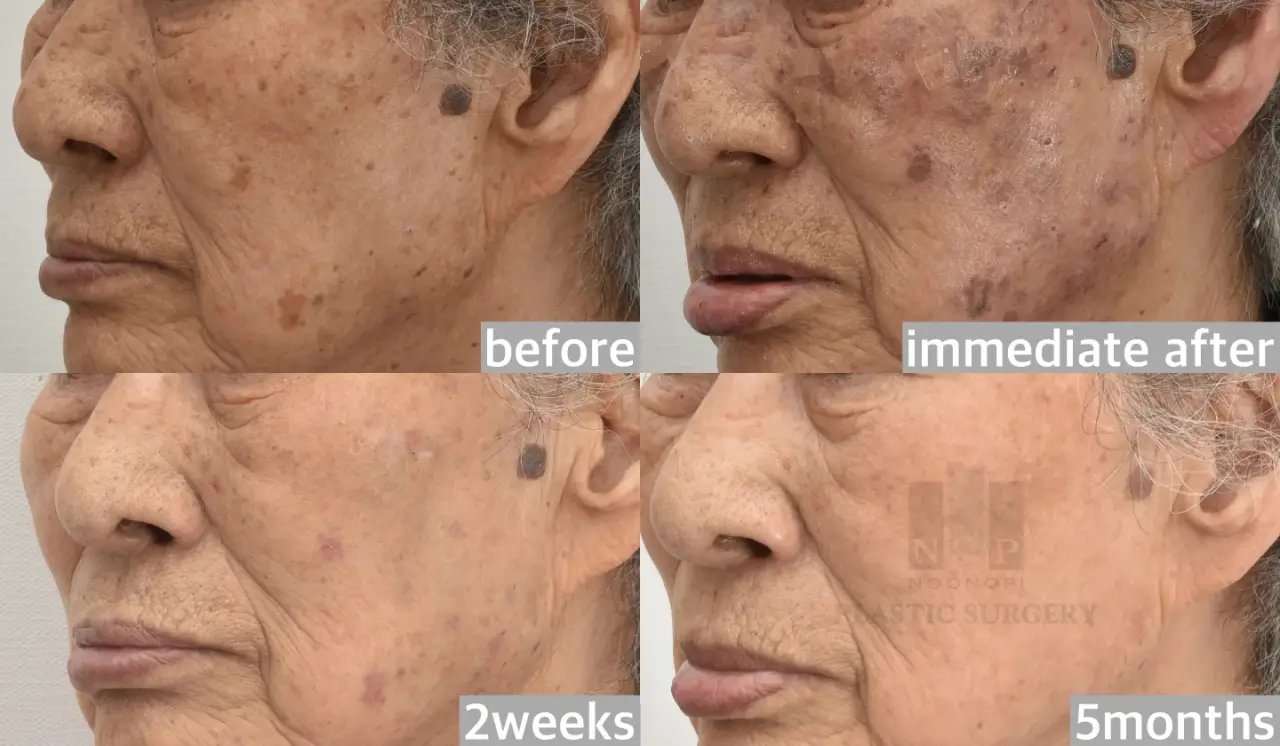 BBL skin laser results
