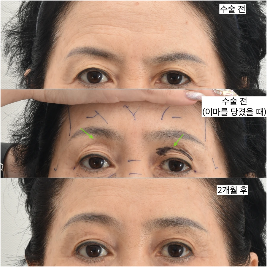 Simultaneous upper eyelid fat graft and brow lift surgery results