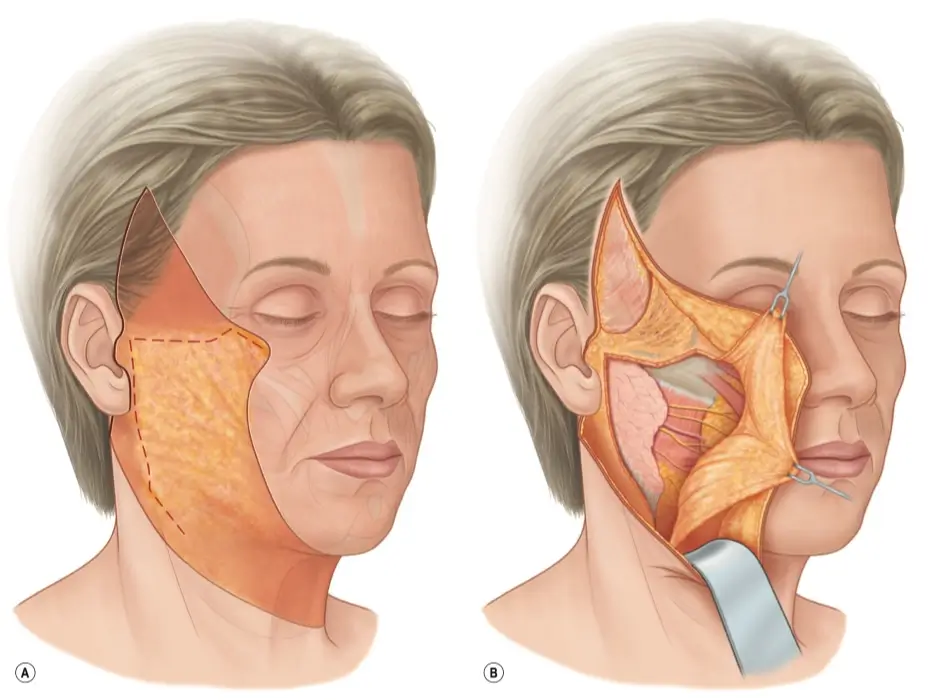 SMAS facelift Korea