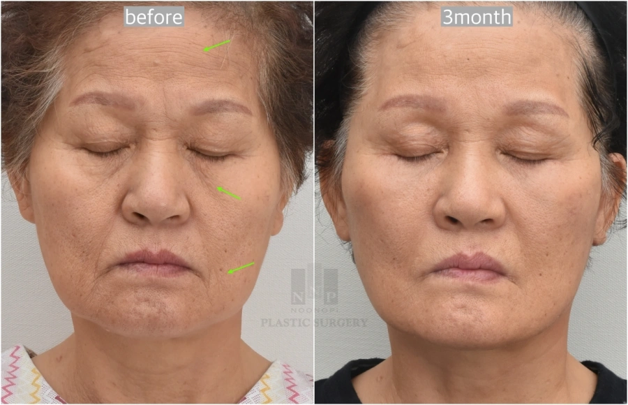 before after facelift korea
