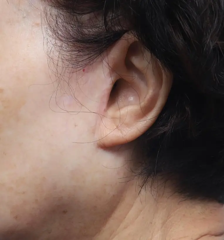 facelift chopped-off tragus example