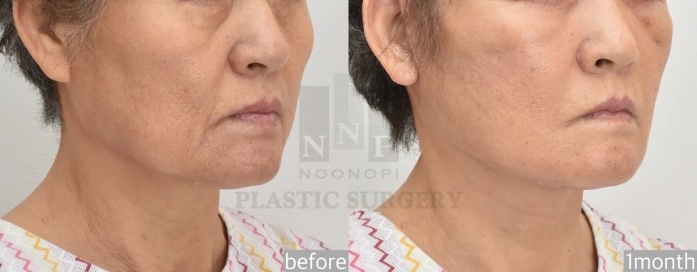 facelift surgery korea before after