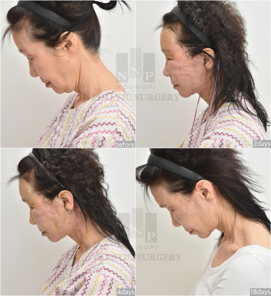 deep plane facelift day by day