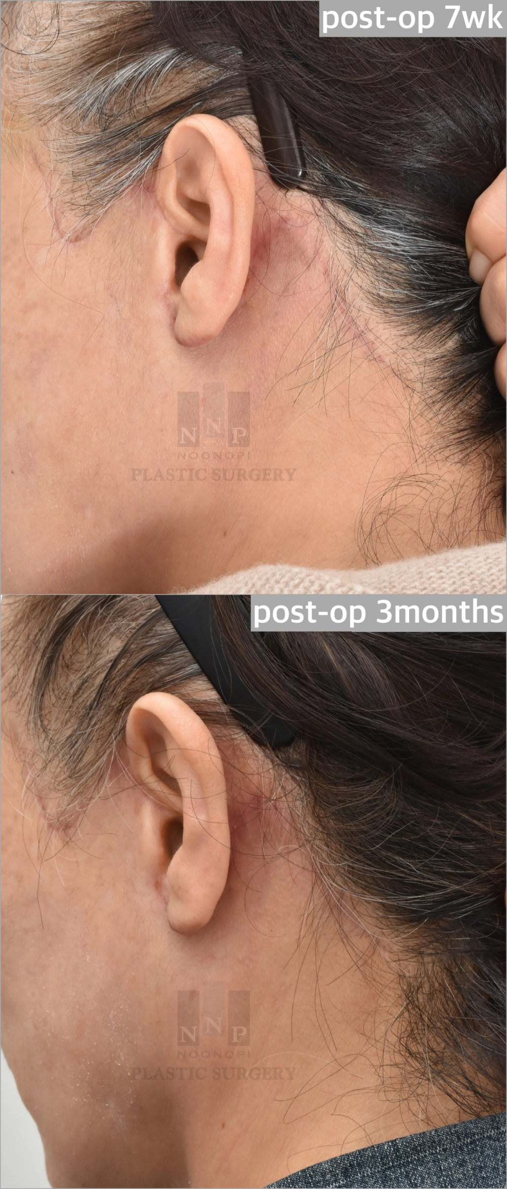 Proper placement of incision ensures less visible scars
