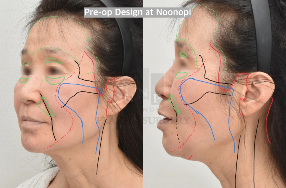 planning of facelift surgery in korean