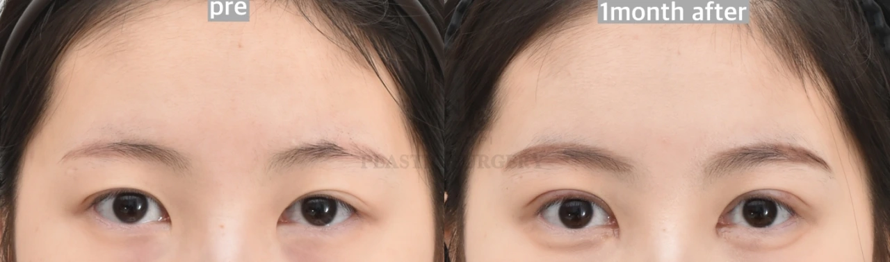 double eyelid before after by Korean plastic surgeon