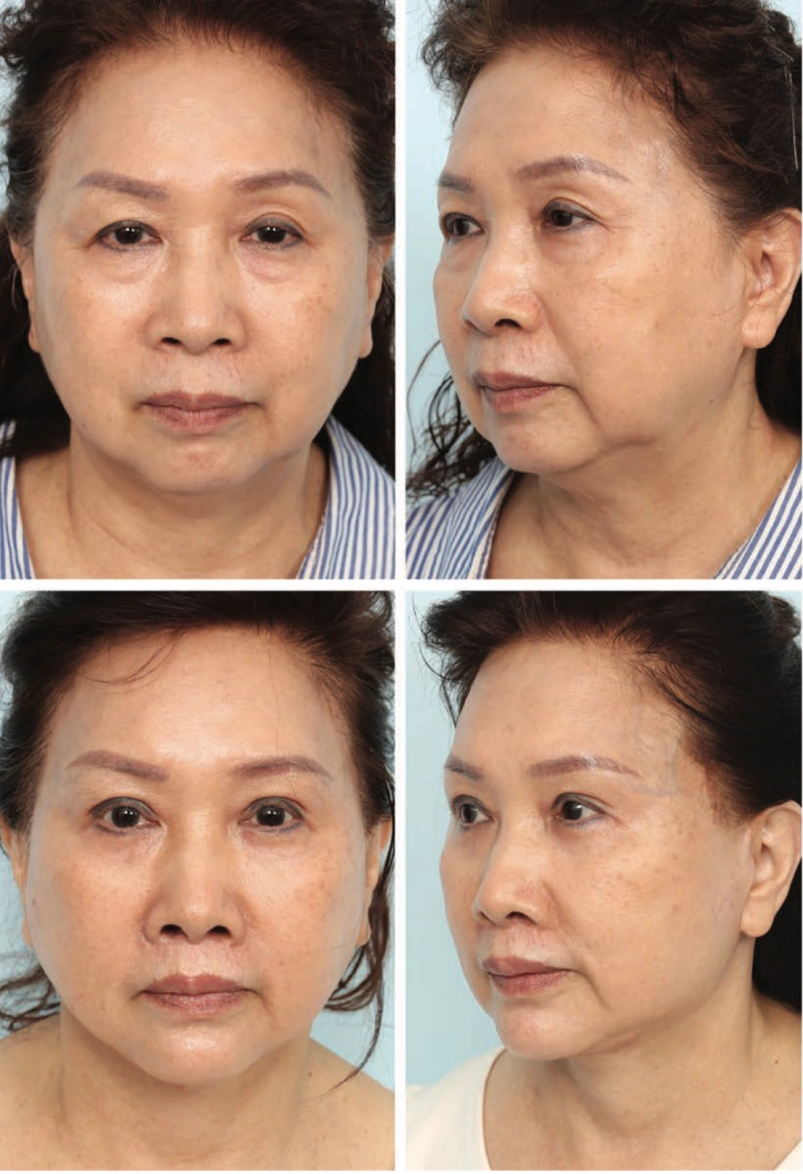 deep plane facelifting poor results