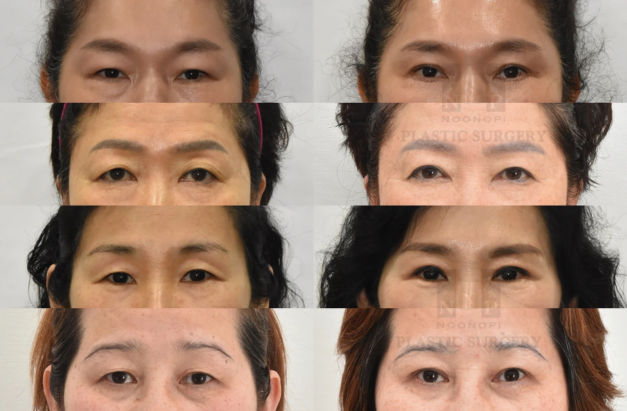 Natural upper eyelid lift Korea