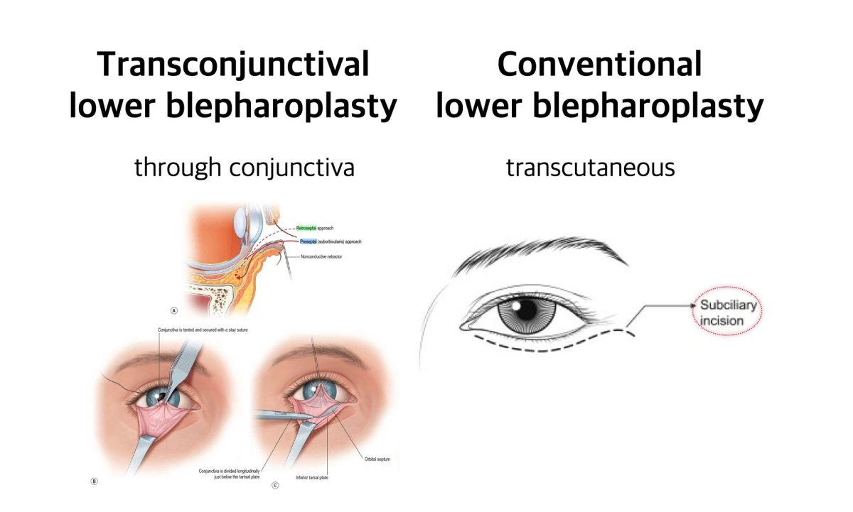 lower blepharoplasty cost Korea compared