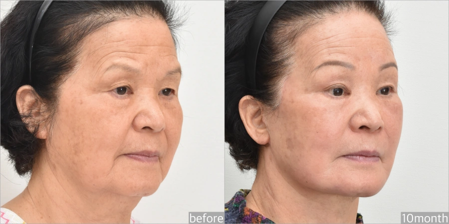 before and after Asian facelift