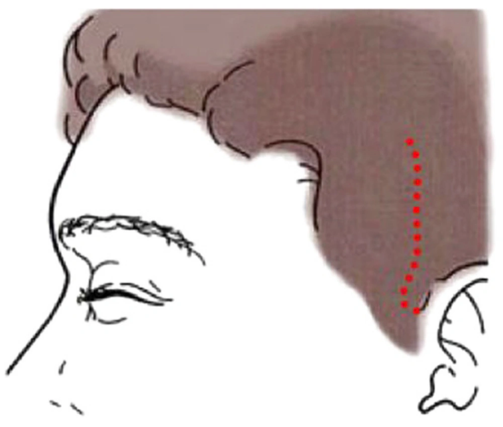 Hairline incision vs along-hairline placement comparison
