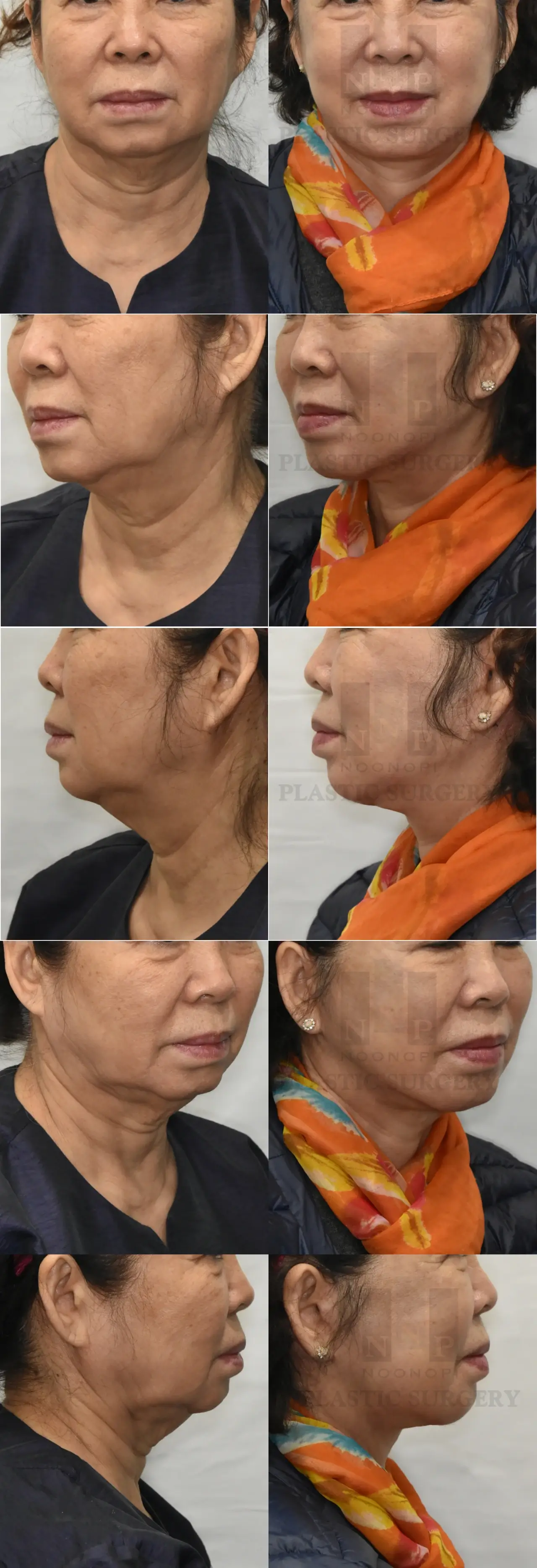 facelift before after at Korean Plastic Surgeon