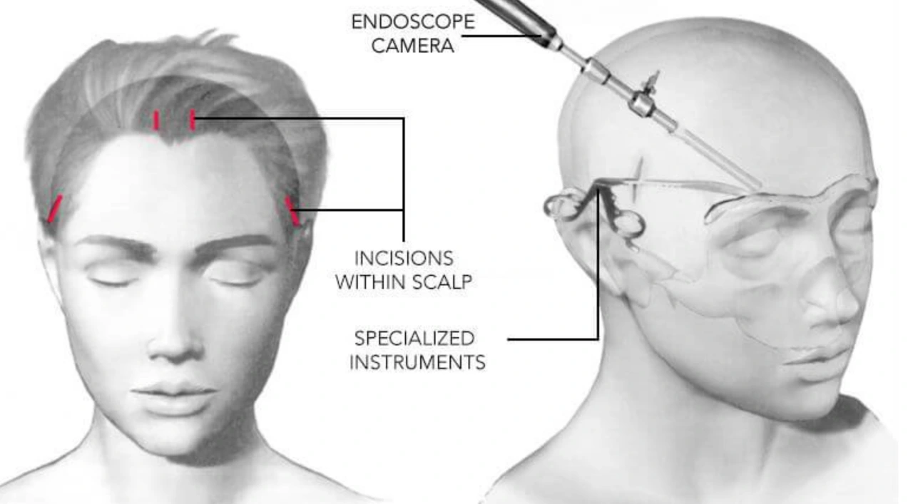 Endoscopic brow lift surgery scar location hidden in hairline