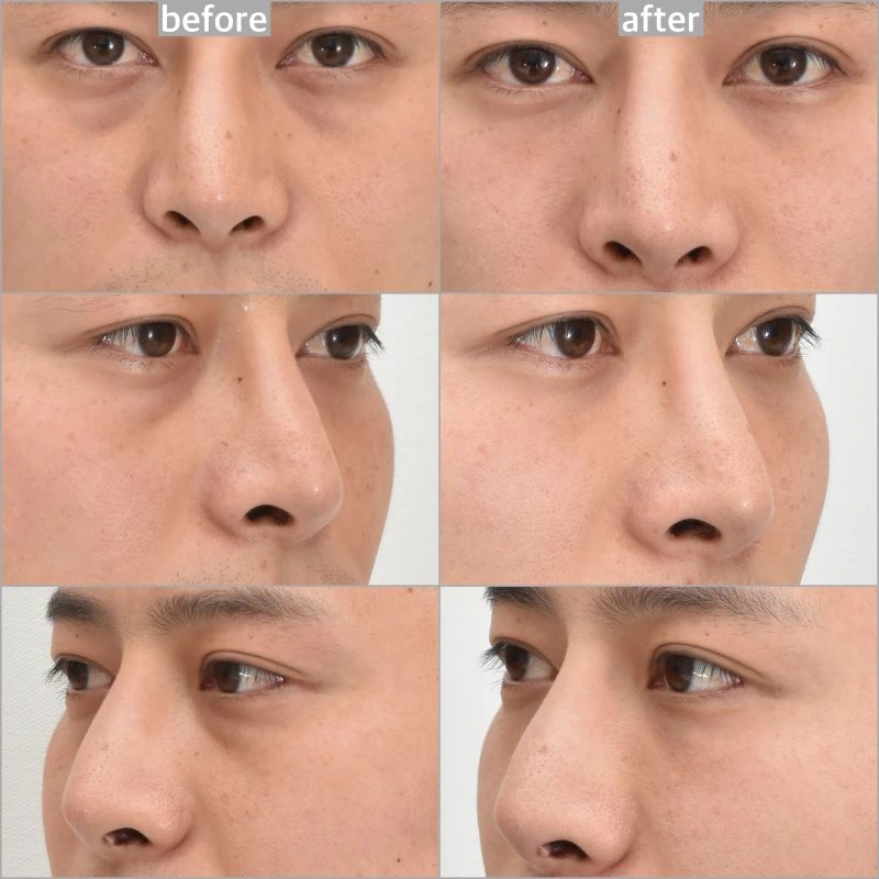 4month after dark circle treatment