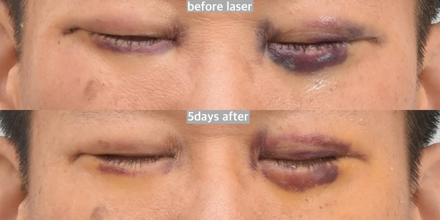 plastic surgery bruising
