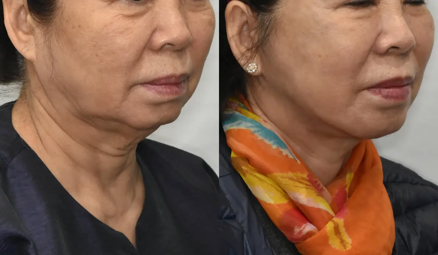 neck lift korea