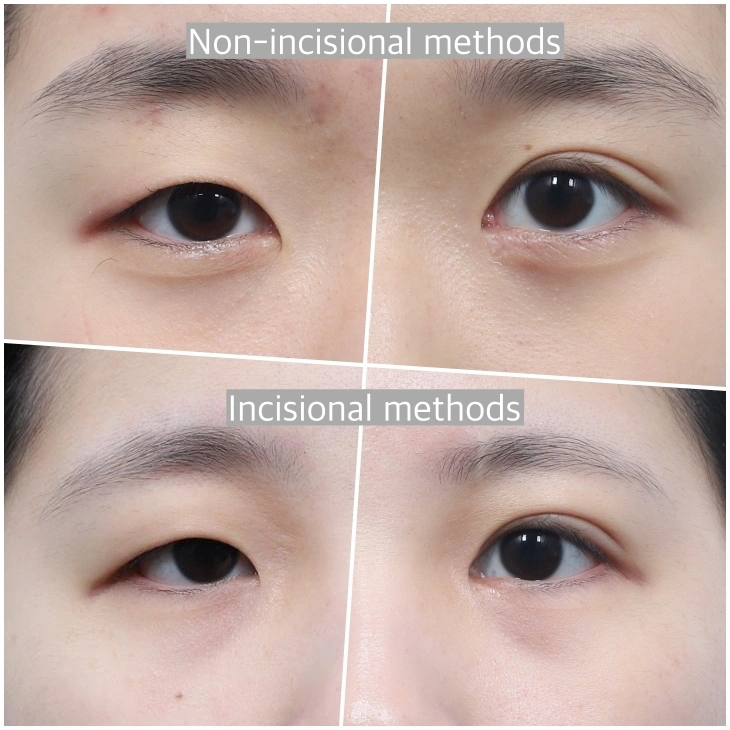 comparision of double eyelid between incision and non-incision