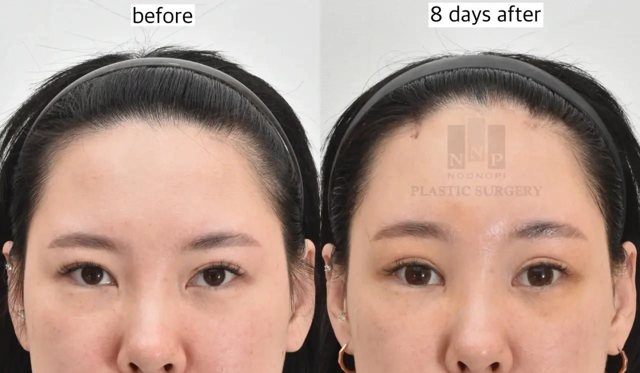 Endoscopic brow lift in a patient in their 20s