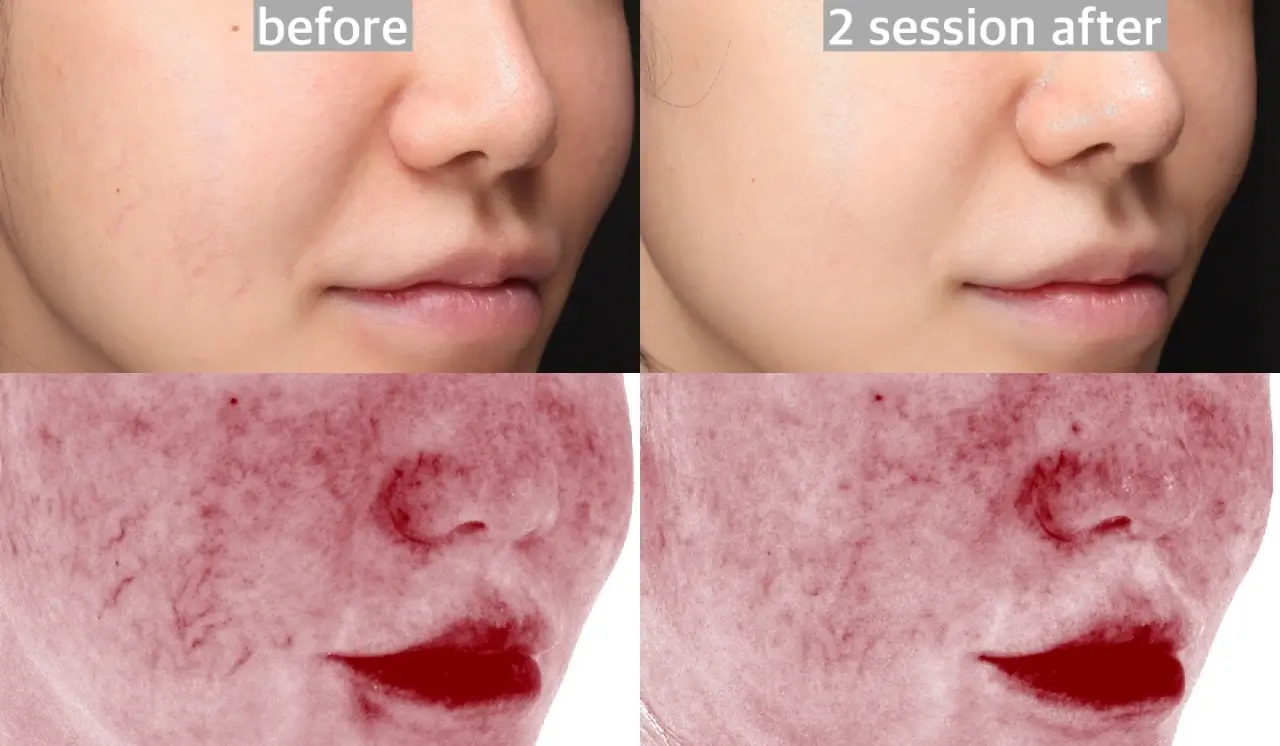 Results of facial vessel with BBL laser
