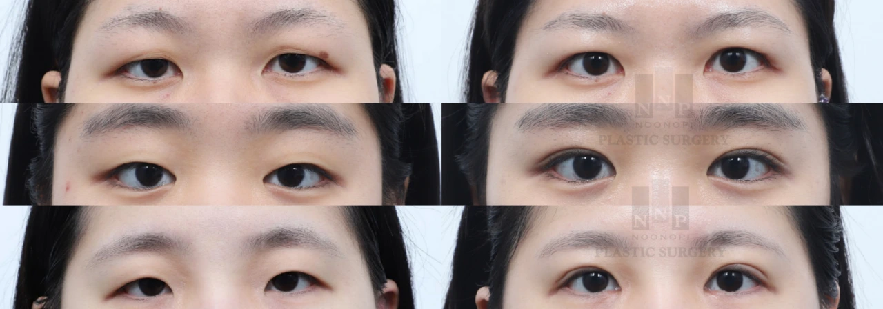 before and after photos of double eyelid surgery in Korea
