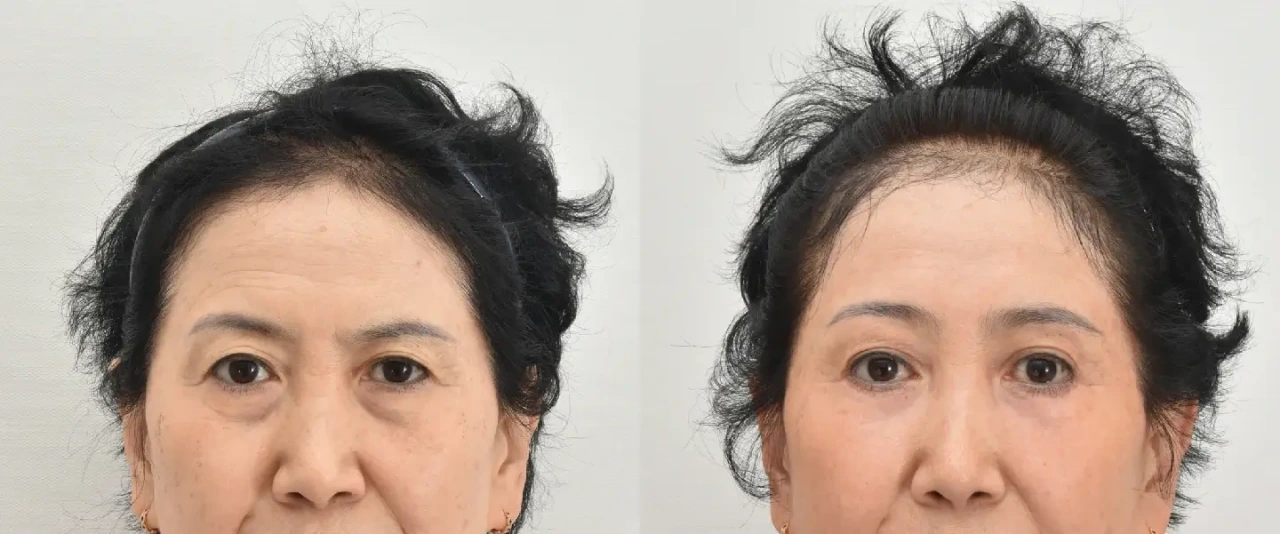 forehead lift in Korea