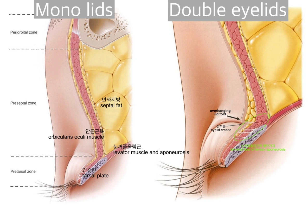 Anatomic difference of mono lids and double eyelids