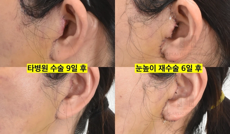 안면거상 귀 부작용 교정 사례