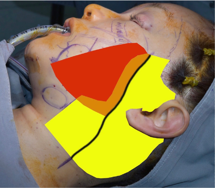 Asian Facelift Taek Keun Kwon