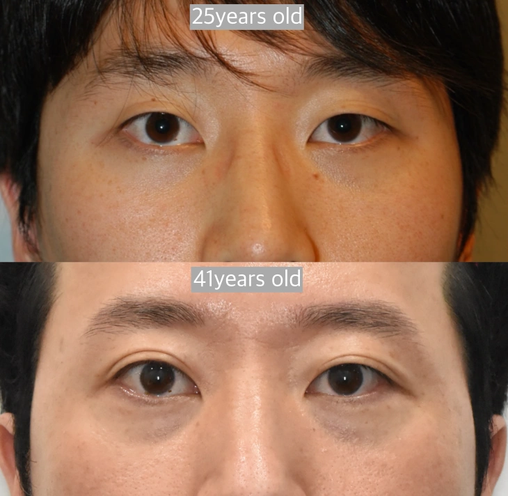 natural folds with aging eyelid
