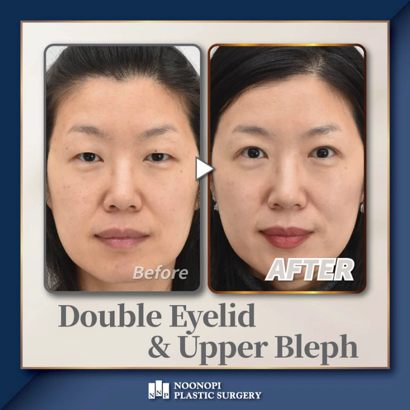 Upper eyelid blepharoplasty in Korea