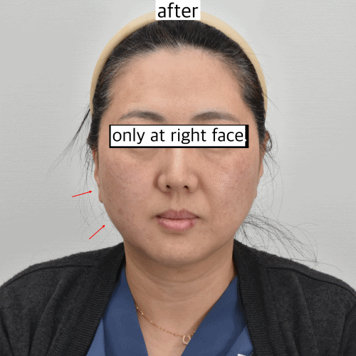 split face XERF lifting result photo