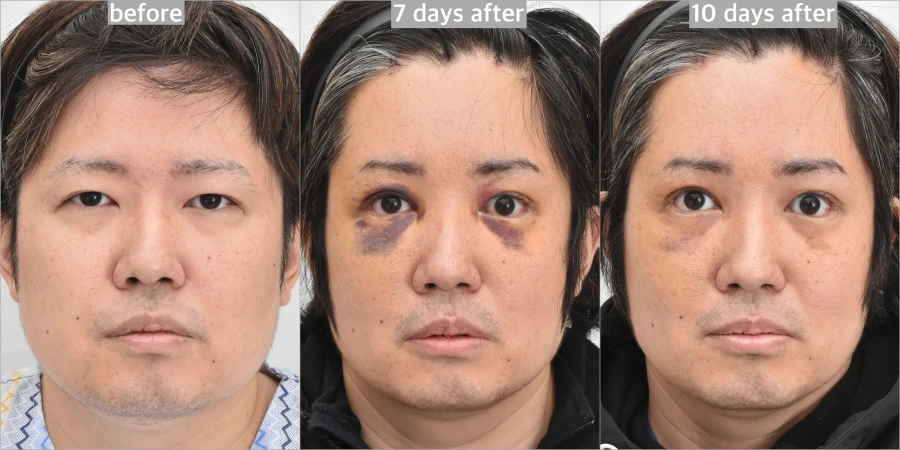 bruise-reducing laser in Korea