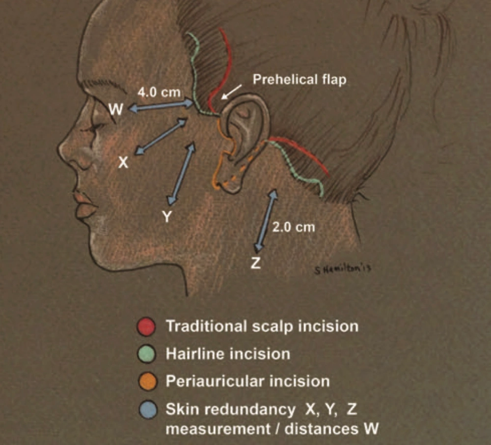 Incision placement options in facelift