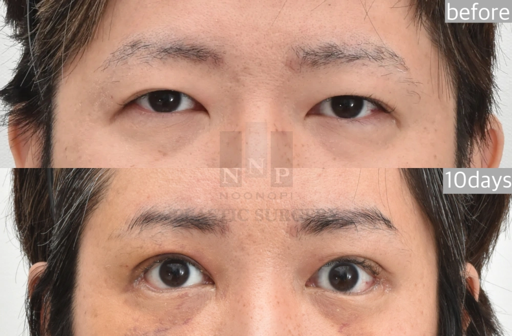 Ptosis surgery before after
