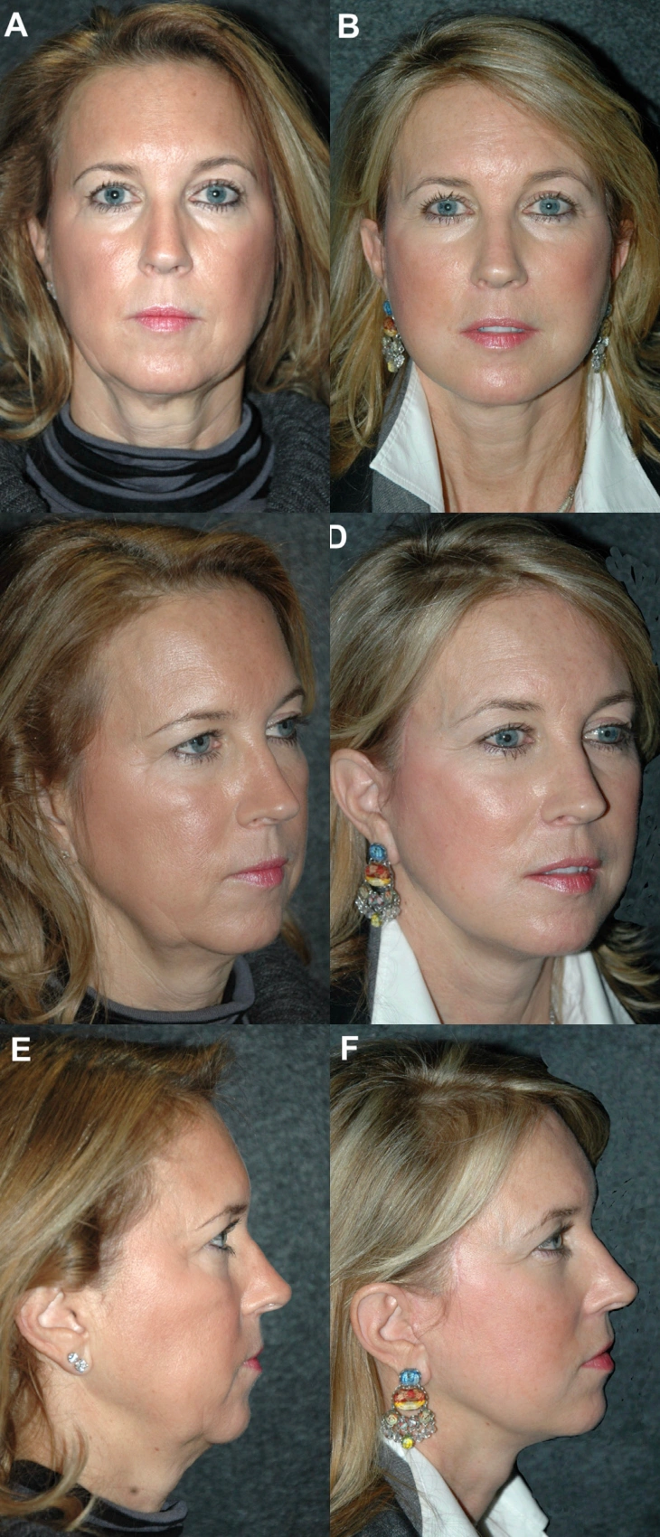 depp plane facelift results