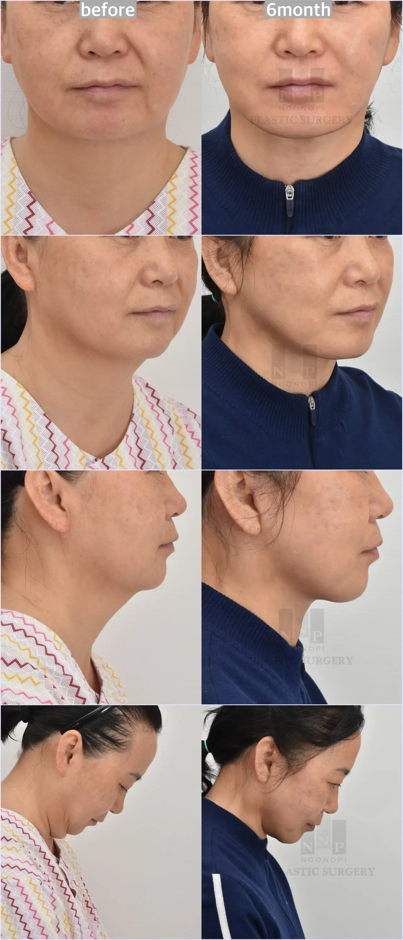 noonopi clinic combined facelift necklift patient review