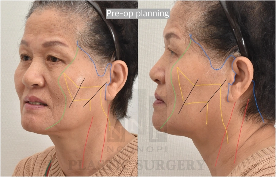 incision placement in facelift korea