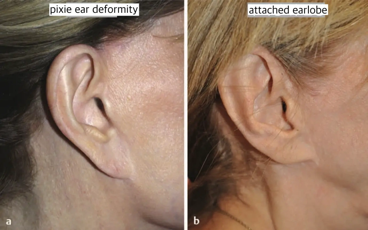facelift ear deformity