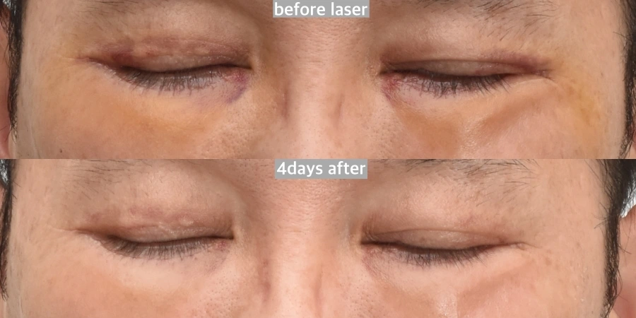 laser for bruising before after