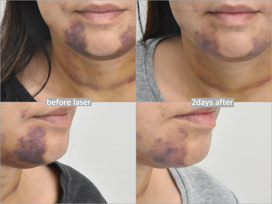 smooth plastic recovery needs laser treatment