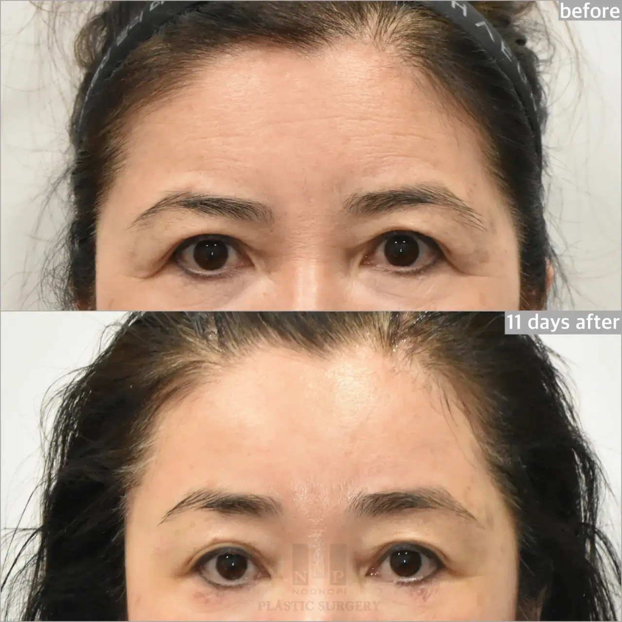 endoscopic brow lift before after